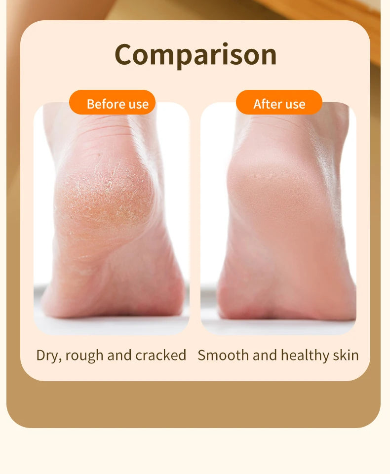 Electric Foot Callus Remover – Rechargeable Pedicure Tool for Smooth, Soft Feet